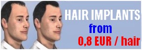 Hair implants